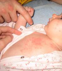 Children's infectious diseases accompanied by a rash The nature of the rash in various diseases